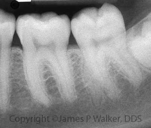 Complex Molar Anatomy